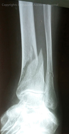 distal-before